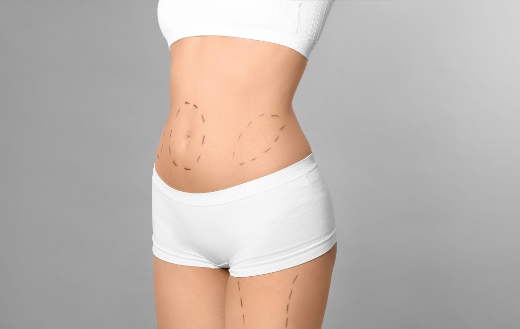 liposuction